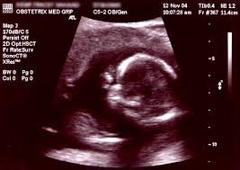 Routine ultrasound USG