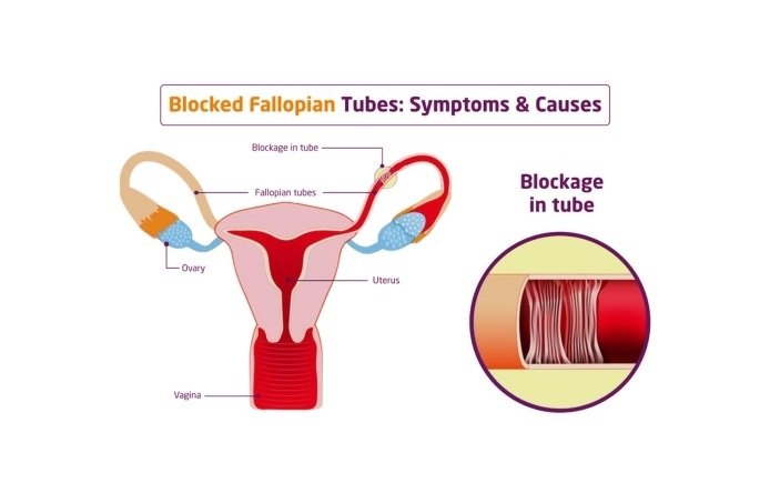 Fallopian Tube Recanalization